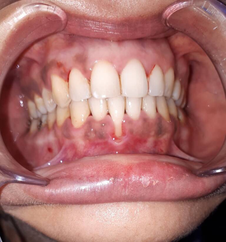 Dentaire Docteur Idriss Cherkaoui, Rabat La carie dentaire